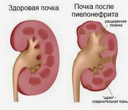 Мегауретер у новонародженого причини, симптоми і лікування (лікування) Мегауретер у новонародженого причини, симптоми і лікування