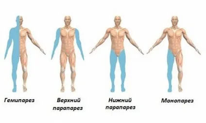 Монопарез кінцівки (руки або ноги) симптоми, причини, лікування (кінцівки руки ноги) Монопарез кінцівки (руки або ноги) симптоми, причини, лікування