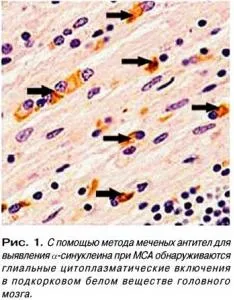 мультисистемная атрофія