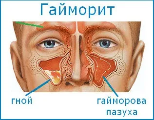 Початкова стадія гаймориту, як розпізнати і лікувати
