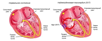 Надшлуночкова тахікардія причини, симптоми і лікування пароксизму (симптоми) Надшлуночкова тахікардія причини, симптоми і лікування пароксизму