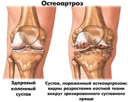 Що робити, якщо хрустять суглоби як позбутися від хрускоту (суглоби) Що робити, якщо хрустять суглоби як позбутися від хрускоту