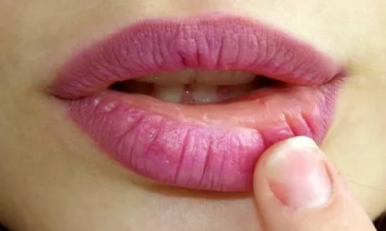 Народні засоби від застуди на губах (кошти) Народні засоби від застуди на губах
