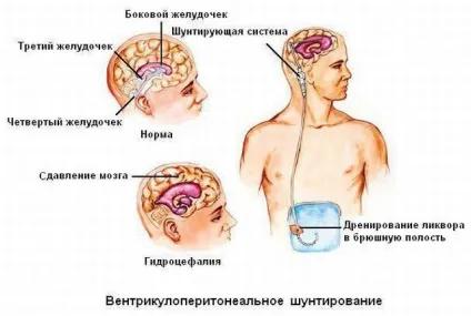 Нейроцистицеркоз головного мозку симптоми, лікування, ускладнення, профілактика (нейроцистицеркоз фото) Нейроцистицеркоз головного мозку симптоми, лікування, ускладнення, профілактика