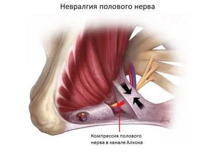 Нейропатія статевого (сороміцького) нерва в Житомирі, клініка урогінекології і нейроурології (сороміцького) Нейропатія статевого (сороміцького) нерва в Житомирі, клініка урогінекології і нейроурології