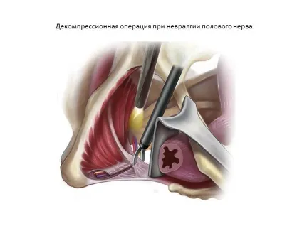 Нейропатія статевого (сороміцького) нерва в Житомирі, клініка урогінекології і нейроурології (статевого) Нейропатія статевого (сороміцького) нерва в Житомирі, клініка урогінекології і нейроурології