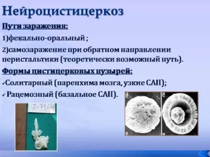 Нейроцистицеркоз головного мозку симптоми, лікування, ускладнення, профілактика (мозку) Нейроцистицеркоз головного мозку симптоми, лікування, ускладнення, профілактика