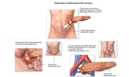 Нове в лікуванні діабету 1 типу основні напрямки терапії