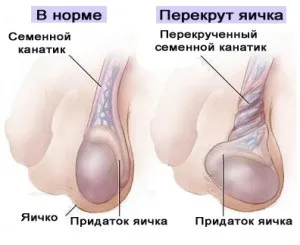 Одне яєчко вище іншого - норма, але варто знати деякі але (іншого) Одне яєчко вище іншого - норма, але варто знати деякі але