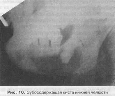 Одонтогенні новоутворення і кісти верхньої і нижньої щелеп (нижньої) Одонтогенні новоутворення і кісти верхньої і нижньої щелеп