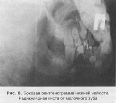 Одонтогенні новоутворення і кісти верхньої і нижньої щелеп (щелеп) Одонтогенні новоутворення і кісти верхньої і нижньої щелеп