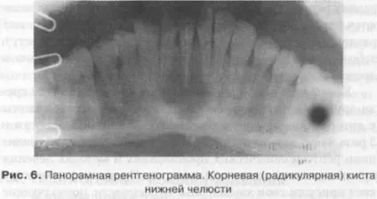 Одонтогенні новоутворення і кісти верхньої і нижньої щелеп (одонтогенні) Одонтогенні новоутворення і кісти верхньої і нижньої щелеп
