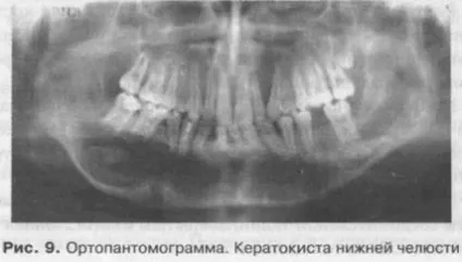 Одонтогенні новоутворення і кісти верхньої і нижньої щелеп (одонтогенні) Одонтогенні новоутворення і кісти верхньої і нижньої щелеп