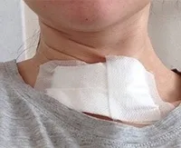 Операції на щитовидній залозі що можна робити і є, шви після хірургічного втручання (є) Операції на щитовидній залозі що можна робити і є, шви після хірургічного втручання