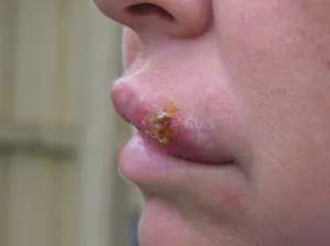 Ускладнення після герпесу бувають двох видів (ускладнення) Ускладнення після герпесу бувають двох видів