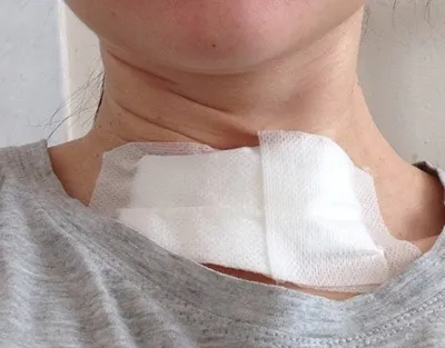 Операції на щитовидній залозі що можна робити і є, шви після хірургічного втручання (робити) Операції на щитовидній залозі що можна робити і є, шви після хірургічного втручання