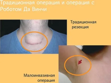 Операції на щитовидній залозі що можна робити і є, шви після хірургічного втручання (щитовидної) Операції на щитовидній залозі що можна робити і є, шви після хірургічного втручання