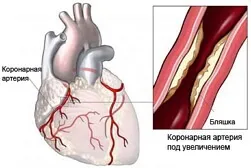 Гострий коронарний синдром - лікування, діагностика, причини (синдром) Гострий коронарний синдром - лікування, діагностика, причини