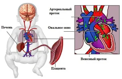 Відкрите овальне вікно в серце у дитини, у дорослого лікування, симптоми, діагноз (відкрите овальне вікно в серце у дорослого) Відкрите овальне вікно в серце у дитини, у дорослого лікування, симптоми, діагноз