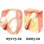 Папули і пустули, секрети народної медицини (пустули) Папули і пустули, секрети народної медицини
