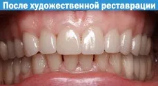 Патологічна стертість зубів - лікувати (стирання) Патологічна стертість зубів - лікувати