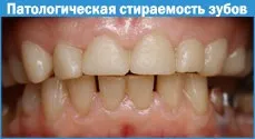 Патологічна стертість зубів - лікувати (стирання) Патологічна стертість зубів - лікувати