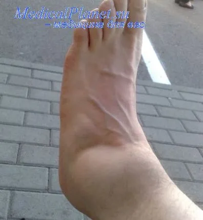 перелом мезонів
