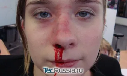 Перелом носа - відкриті і закриті травми кісток і спинки (тільки) Перелом носа - відкриті і закриті травми кісток і спинки
