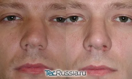 Перелом носа - відкриті і закриті травми кісток і спинки (кісток) Перелом носа - відкриті і закриті травми кісток і спинки