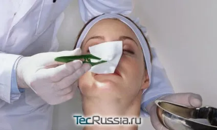Перелом носа - відкриті і закриті травми кісток і спинки (кісток) Перелом носа - відкриті і закриті травми кісток і спинки