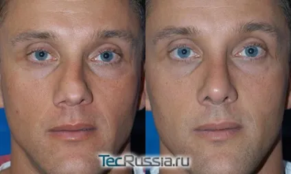 Перелом носа - відкриті і закриті травми кісток і спинки (операції) Перелом носа - відкриті і закриті травми кісток і спинки