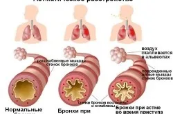 Персистирующая бронхіальна астма лікування (астма) Персистирующая бронхіальна астма лікування