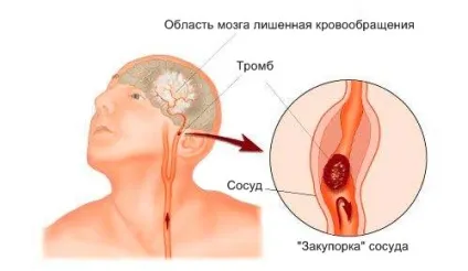 Харчування після інсульту продукти (продукти) Харчування після інсульту продукти
