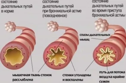 Персистирующее легкий перебіг бронхіальної астми атопічний форми (протягом) Персистирующее легкий перебіг бронхіальної астми атопічний форми