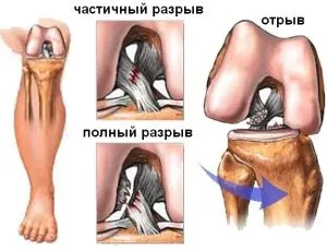 Що викликає нестабільність колінного суглоба симптоми, лікування (колінного) Що викликає нестабільність колінного суглоба симптоми, лікування