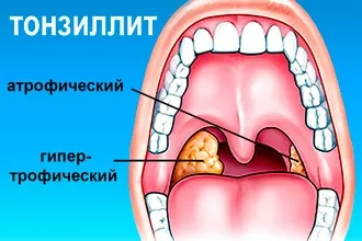 Що таке катаральний риніт - лікування гострого та хронічного нежитю (катаральний) Що таке катаральний риніт - лікування гострого та хронічного нежитю