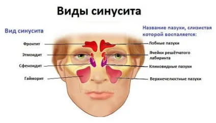 Що таке синусит види, причини, симптоми, лікування, все про лікування нежиті і гаймориту!