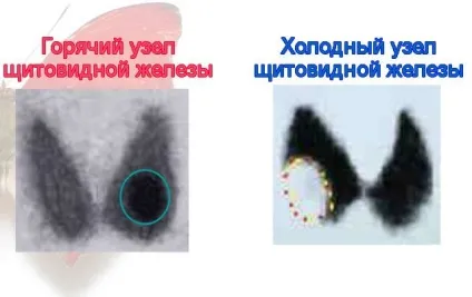 Що таке холодний вузол і гарячий вузол щитовидної залози