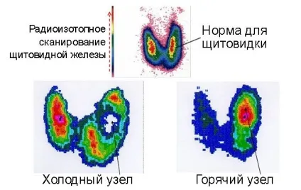 Що таке холодний вузол і гарячий вузол щитовидної залози