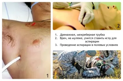 Що таке невмоторакс, причини виникнення, як протікає, відео