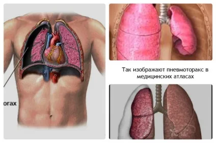 Що таке невмоторакс, причини виникнення, як протікає, відео