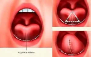 Підрізання вуздечки під язиком у дітей пластика вуздечки язика (мовою) Підрізання вуздечки під язиком у дітей пластика вуздечки язика