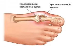 Подагра на ногах симптоми і ознаки, лікування, масаж, народні засоби і профілактика захворювання (подагра) Подагра на ногах симптоми і ознаки, лікування, масаж, народні засоби і профілактика захворювання