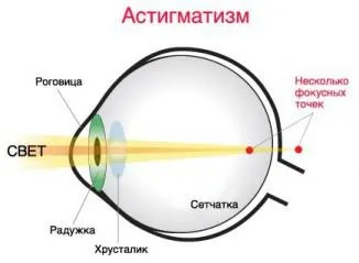 Підбір торических лінз що це таке, як одягати, кольорові, що означає, чим відрізняються від звичайних, (лінз) Підбір торических лінз що це таке, як одягати, кольорові, що означає, чим відрізняються від звичайних,