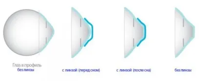 Підбір торических лінз що це таке, як одягати, кольорові, що означає, чим відрізняються від звичайних, (значить) Підбір торических лінз що це таке, як одягати, кольорові, що означає, чим відрізняються від звичайних,