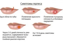 Наслідки герпесу на тілі людини основні групи (фото і відео) (наслідки) Наслідки герпесу на тілі людини основні групи (фото і відео)