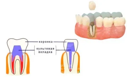 Підвищена стираемость зубів - симптоми і способи лікування (зубів) Підвищена стираемость зубів - симптоми і способи лікування