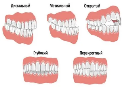Правильний прикус як розпізнати причини неправильного прикусу (прикус) Правильний прикус як розпізнати причини неправильного прикусу