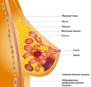 Рак грудей - лікування карциноми молочної залози 1, 2, 3 стадії, хіміотерапія при раку грудей (3, 4 (грудей) Рак грудей - лікування карциноми молочної залози 1, 2, 3 стадії, хіміотерапія при раку грудей (3, 4