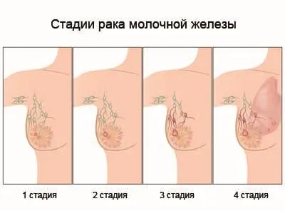 Рак грудей - лікування карциноми молочної залози 1, 2, 3 стадії, хіміотерапія при раку грудей (3, 4 (молочної) Рак грудей - лікування карциноми молочної залози 1, 2, 3 стадії, хіміотерапія при раку грудей (3, 4